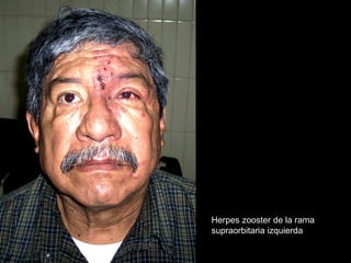 Herpes zooster de la rama
supraorbitaria izquierda
 