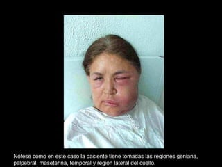 Nótese como en este caso la paciente tiene tomadas las regiones geniana,
palpebral, maseterina, temporal y región lateral del cuello.
 