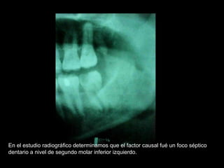 En el estudio radiográfico determinamos que el factor causal fué un foco séptico
dentario a nivel de segundo molar inferior izquierdo.
 