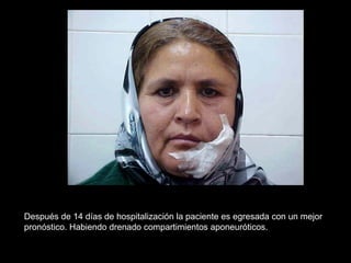 Después de 14 días de hospitalización la paciente es egresada con un mejor
pronóstico. Habiendo drenado compartimientos aponeuróticos.
 