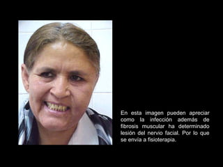 En esta imagen pueden apreciar
como la infección además de
fibrosis muscular ha determinado
lesión del nervio facial. Por lo que
se envía a fisioterapia.
 
