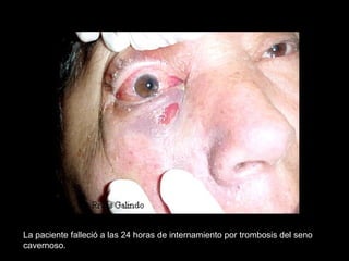 La paciente falleció a las 24 horas de internamiento por trombosis del seno
cavernoso.
 