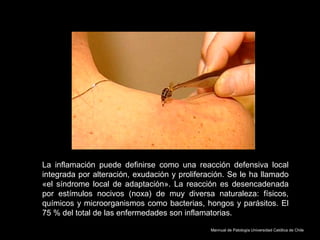 La inflamación puede definirse como una reacción defensiva local
integrada por alteración, exudación y proliferación. Se le ha llamado
«el síndrome local de adaptación». La reacción es desencadenada
por estímulos nocivos (noxa) de muy diversa naturaleza: físicos,
químicos y microorganismos como bacterias, hongos y parásitos. El
75 % del total de las enfermedades son inflamatorias.
Mannual de Patología Universidad Católica de Chile
 