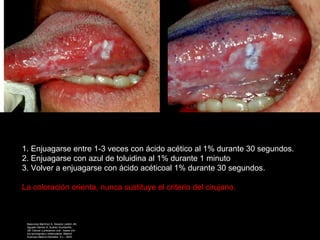 Técnica de aplicación
1. Enjuagarse entre 1-3 veces con ácido acético al 1% durante 30 segundos.
2. Enjuagarse con azul de toluidina al 1% durante 1 minuto
3. Volver a enjuagarse con ácido acéticoal 1% durante 30 segundos.
La coloración orienta, nunca sustituye el criterio del cirujano.
Bascones Martínez A, Seoane Lestón JM,
Aguado Santos A, Suárez Quintanilla
JM. Cáncer y precáncer oral : bases clín
ico-quirúrgicas y moleculares. Madrid:
Avances Medico-Dentales, S.L.; 2003.
 