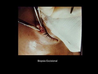 Biopsia Excisional
 