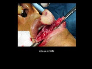 Biopsia directa
 