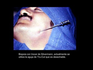 Biopsia con trocar de Silvermann, actualmente se
utiliza la aguja de Tru-Cut que es desechable.
 