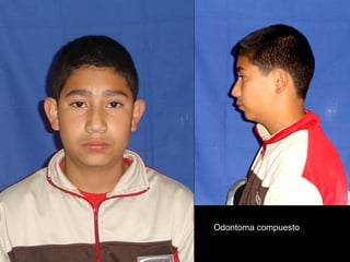 Odontoma compuesto
 
