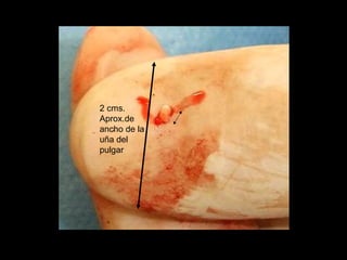2 cms.
Aprox.de
ancho de la
uña del
pulgar
 