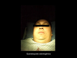 Queratoquiste odontogénico
 