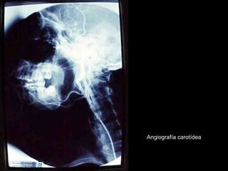 Angiografía carotídea
 