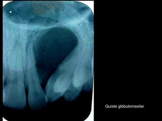 Quiste glóbulomaxilar
 