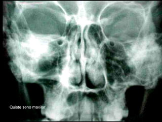 Quiste seno maxilar
 