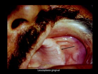 Leucoplasia gingival
 