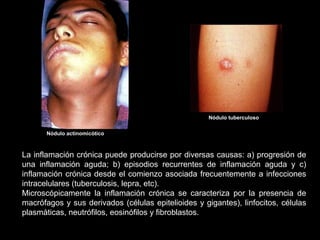 La inflamación crónica puede producirse por diversas causas: a) progresión de
una inflamación aguda; b) episodios recurrentes de inflamación aguda y c)
inflamación crónica desde el comienzo asociada frecuentemente a infecciones
intracelulares (tuberculosis, lepra, etc).
Microscópicamente la inflamación crónica se caracteriza por la presencia de
macrófagos y sus derivados (células epitelioides y gigantes), linfocitos, células
plasmáticas, neutrófilos, eosinófilos y fibroblastos.
Nódulo tuberculoso
Nódulo actinomicótico
 
