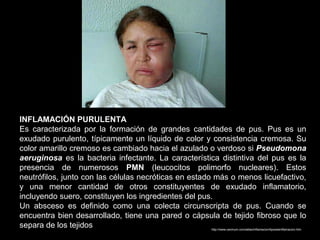 INFLAMACIÓN PURULENTA
Es caracterizada por la formación de grandes cantidades de pus. Pus es un
exudado purulento, típicamente un líquido de color y consistencia cremosa. Su
color amarillo cremoso es cambiado hacia el azulado o verdoso si Pseudomona
aeruginosa es la bacteria infectante. La característica distintiva del pus es la
presencia de numerosos PMN (leucocitos polimorfo nucleares). Estos
neutrófilos, junto con las células necróticas en estado más o menos licuefactivo,
y una menor cantidad de otros constituyentes de exudado inflamatorio,
incluyendo suero, constituyen los ingredientes del pus.
Un absceso es definido como una colecta circunscripta de pus. Cuando se
encuentra bien desarrollado, tiene una pared o cápsula de tejido fibroso que lo
separa de los tejidos http://www.caninum.com/atlas/inflamacion/tiposdeinflamacion.htm
 