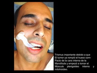 Trismus importante debido a que
El tumor ya rompió el hueso com-
Pacto de la cara interna de la
Mandíbula y empezó a tomar el
Músculo pterigoideo interno y
milohioideo.
 