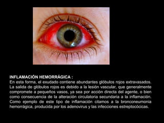INFLAMACIÓN HEMORRÁGICA :
En esta forma, el exudado contiene abundantes glóbulos rojos extravasados.
La salida de glóbulos rojos es debido a la lesión vascular, que generalmente
compromete a pequeños vasos, ya sea por acción directa del agente, o bien
como consecuencia de la alteración circulatoria secundaria a la inflamación.
Como ejemplo de este tipo de inflamación citamos a la bronconeumonia
hemorrágica, producida por los adenovirus y las infecciones estreptocócicas.
 