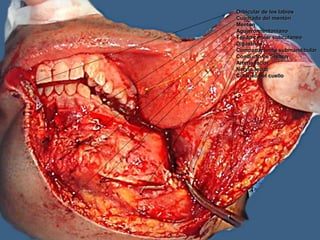 Orbicular de los labiosOrbicular de los labios
Cuadrado del mentónCuadrado del mentón
MentónMentón
Agujero mentonianoAgujero mentoniano
Tejido celular subcutáneoTejido celular subcutáneo
DigástricoDigástrico
Compartimiento submandibularCompartimiento submandibular
Conducto de StenonConducto de Stenon
Arteria facialArteria facial
Nervio facialNervio facial
Cutáneo del cuelloCutáneo del cuello
 