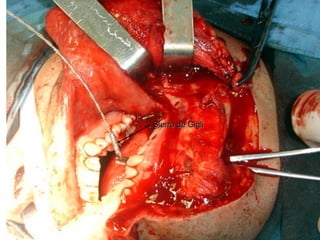 Sierra de GigliSierra de Gigli
 