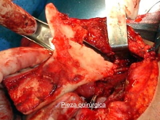 Pieza quirúrgica
 