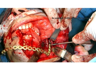 Se respetó el cóndilo para anclar la prótesisSe respetó el cóndilo para anclar la prótesis
 