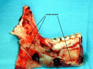 Límite tumoralLímite tumoral
 