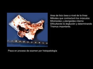 Area de lisis ósea a nivel de la línea
Miliodes que contracturó los músculos
Milohioideo y pterigoideo interno
Dificultando la deglución y determinando
Trismus importante.
Pieza en proceso de examen por histopatología
 