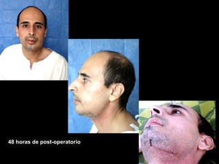 48 horas de post-operatorio
 