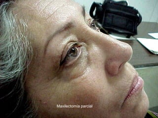 Maxilectomía parcial
 