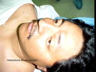 Histiocitoma fibroso benigno
 