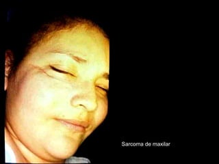 Sarcoma de maxilar
 