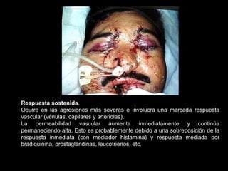Respuesta sostenida.
Ocurre en las agresiones más severas e involucra una marcada respuesta
vascular (vénulas, capilares y arteriolas).
La permeabilidad vascular aumenta inmediatamente y continúa
permaneciendo alta. Esto es probablemente debido a una sobreposición de la
respuesta inmediata (con mediador histamina) y respuesta mediada por
bradiquinina, prostaglandinas, leucotrienos, etc.
 