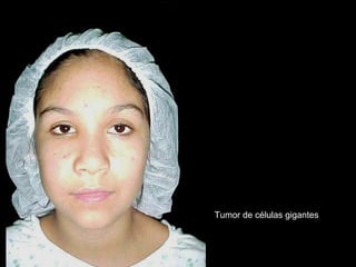 Tumor de células gigantes
 