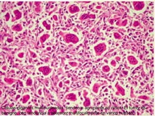 Células gigantes multinucleadas, tienden a agruparse en nidos. El tumor es
benigno, con tendencia a aparecer multifocalmente en varios huesos.
 