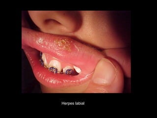 Herpes labial
 