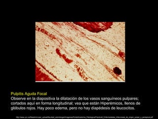 Pulpitis Aguda Focal
Observe en la diapositiva la dilatación de los vasos sanguíneos pulpares;
cortados aquí en forma longitudinal; vea que están Hiperémicos, llenos de
glóbulos rojos. Hay poco edema, pero no hay diapédesis de leucocitos.
http://www.ucv.ve/fileadmin/user_upload/facultad_odontologia/Imagenes/Portal/Anatomia_Patologica/Practica5_Enfermedades_Infecciosas_de_origen_pulpar_y_periapical.pdf
 