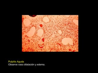 Pulpitis Aguda
Observe vaso dilatación y edema.
 