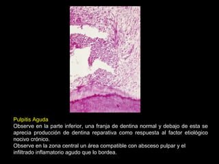 Pulpitis Aguda
Observe en la parte inferior, una franja de dentina normal y debajo de esta se
aprecia producción de dentina reparativa como respuesta al factor etiológico
nocivo crónico.
Observe en la zona central un área compatible con absceso pulpar y el
infiltrado inflamatorio agudo que lo bordea.
 