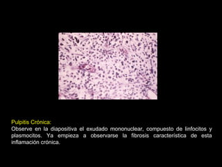 Pulpitis Crónica:
Observe en la diapositiva el exudado mononuclear, compuesto de linfocitos y
plasmocitos. Ya empieza a observarse la fibrosis característica de esta
inflamación crónica.
 