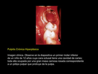 Pulpitis Crónica Hiperplásica
Imagen clínica. Observe en la diapositiva un primer molar inferior
de un niño de 12 años cuya cara oclusal tiene una cavidad de caries;
toda ella ocupada por una gran masa carnosa rosada correspondiente
a un pólipo pulpar que protruye de la pulpa.
 