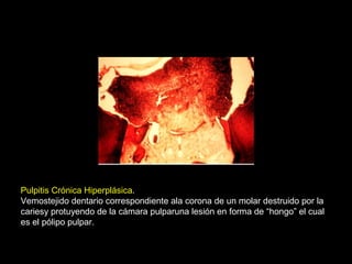 Pulpitis Crónica Hiperplásica.
Vemostejido dentario correspondiente ala corona de un molar destruido por la
cariesy protuyendo de la cámara pulparuna lesión en forma de “hongo” el cual
es el pólipo pulpar.
 
