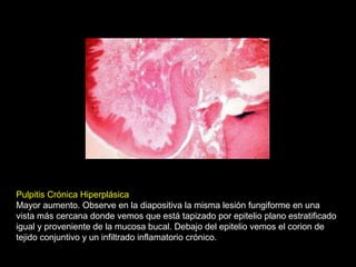 Pulpitis Crónica Hiperplásica
Mayor aumento. Observe en la diapositiva la misma lesión fungiforme en una
vista más cercana donde vemos que está tapizado por epitelio plano estratificado
igual y proveniente de la mucosa bucal. Debajo del epitelio vemos el corion de
tejido conjuntivo y un infiltrado inflamatorio crónico.
 