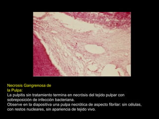 Necrosis Gangrenosa de
la Pulpa:
La pulpitis sin tratamiento termina en necrósis del tejido pulpar con
sobreposición de infección bacteriana.
Observe en la diapositiva una pulpa necrótica de aspecto fibrilar: sin células,
con restos nucleares, sin apariencia de tejido vivo.
 