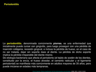La periodontitis, denominada comúnmente piorrea, es una enfermedad que
inicialmente puede cursar con gingivitis, para luego proseguir con una pérdida de
inserción colágena, recesión gingival, e incluso la pérdida de hueso, en el caso de
no ser tratada, dejar sin soporte óseo al diente. La pérdida de dicho soporte
implica la pérdida irreparable del diente mismo.
De etiología bacteriana que afecta al periodonto (el tejido de sostén de los dientes,
constituido por la encía, el hueso alveolar, el cemento radicular y el ligamento
periodontal) se manifiesta más comúnmente en adultos mayores de 35 años, pero
puede iniciarse en edades más tempranas.
Periodontitis
•Zerón Agustín. Nueva clasificación de las enfermedades periodontales. ADM. 2001; LVIII(1):16-20.
 