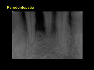 Parodontopatía
 