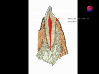Ruptura del anillo de
Kolhiker
 