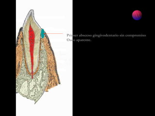Primer absceso gingivodentario sin compromiso
Oseo aparente.
 
