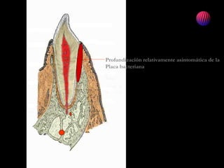 Qué es
Profundización relativamente asintomática de la
Placa bacteriana
 