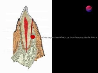 Absceso parodontal severo, con sintomatología franca
 